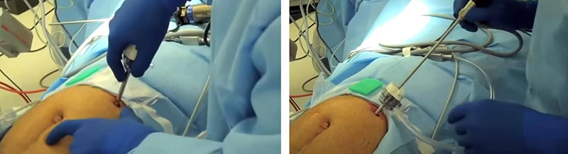 laparoscopy disposable trocar surgery